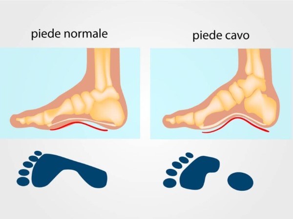 Piede cavo: il vuoto che pesa