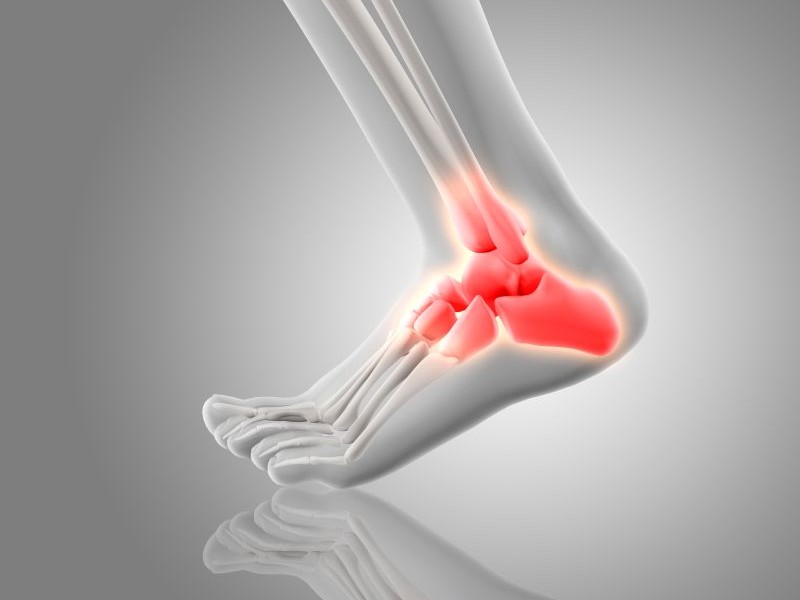 Progettazione e Realizzazione Plantari per Fascite plantare e Spina calcaneare Bergamo Milano Monza Lecco Crema | Ortopedia Tecnica Gasparini Bonate Sopra